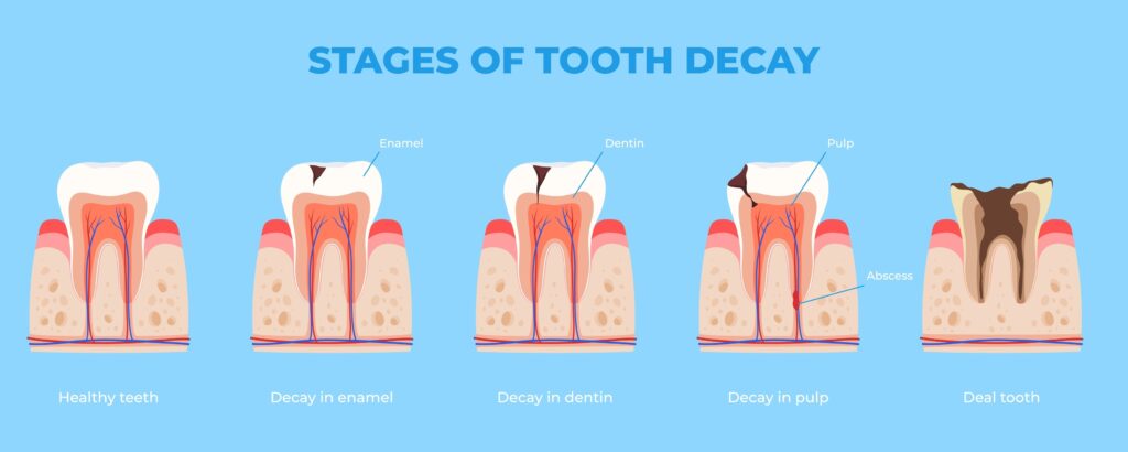 teeth-decay-stages