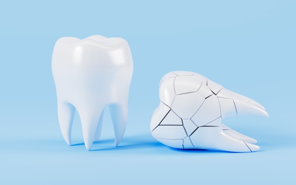 chipped-tooth-prevention