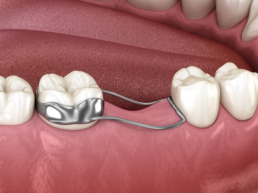 teeth-space-maintainer